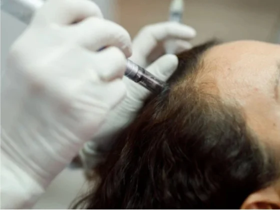 hair-exosomes treatment in bangalore